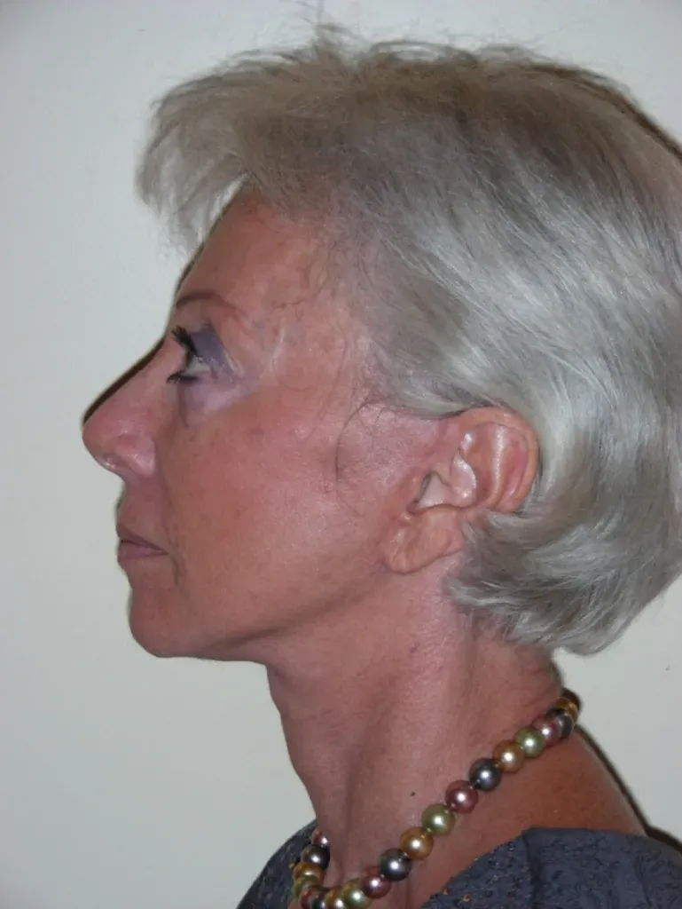 Cervico-facial facelift in France: natural and elegant results with Dr Jean-François Pascal in Lyon
