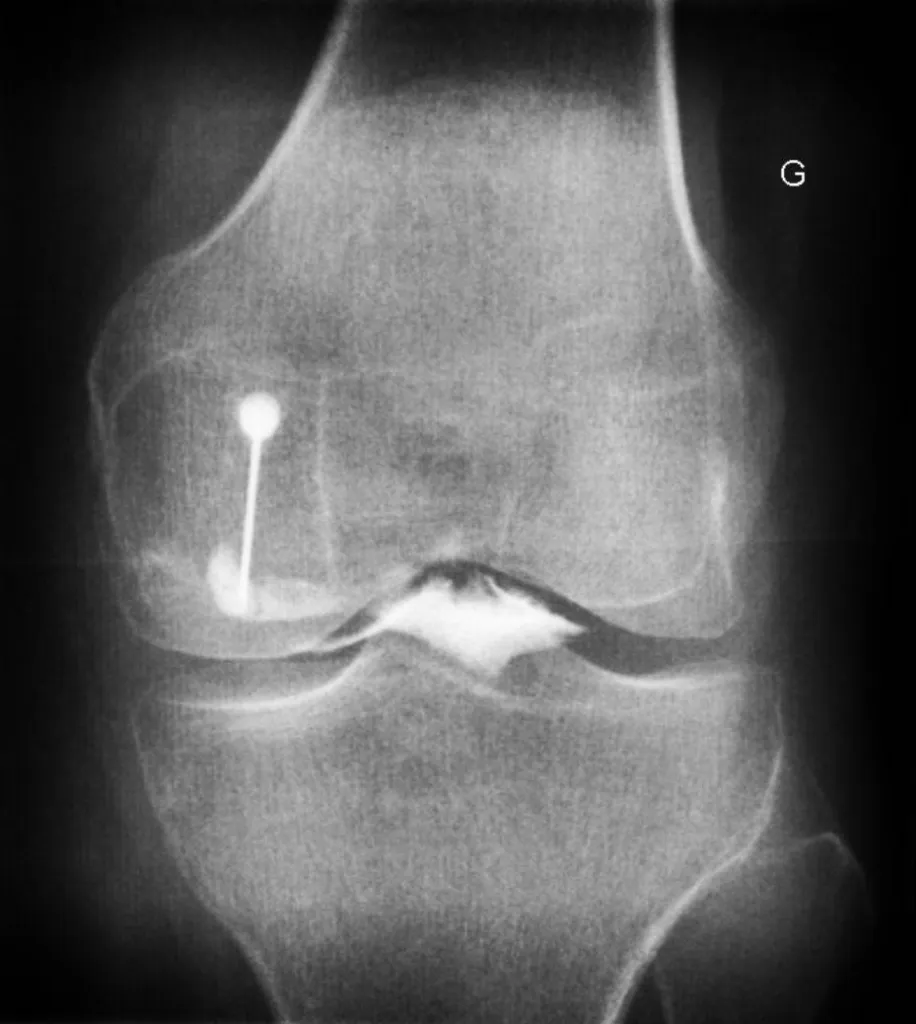 Opacification de l'articulation (arthrographie) du genou avant injection de produit cortisonique pour verifier la bonne position