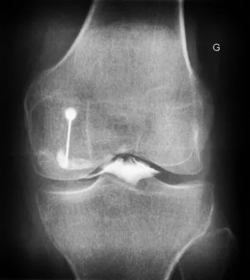 Opacification de l'articulation (arthrographie) du genou avant injection de produit cortisonique pour verifier la bonne position