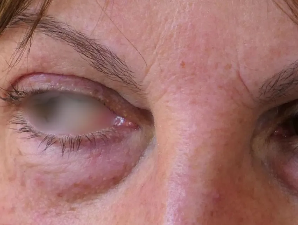 Blépharoplastie à Lyon : rajeunir et éclairer le regard avec le Dr Jean-François Pascal