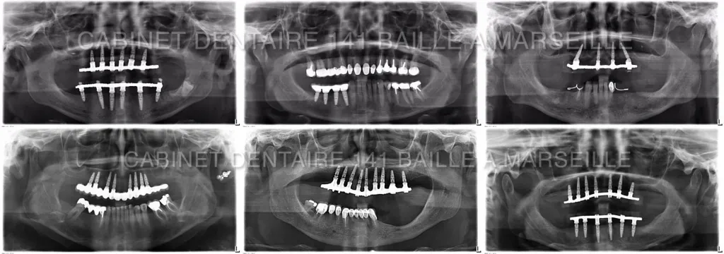 spécialiste remplacement toutes les dents par des implants