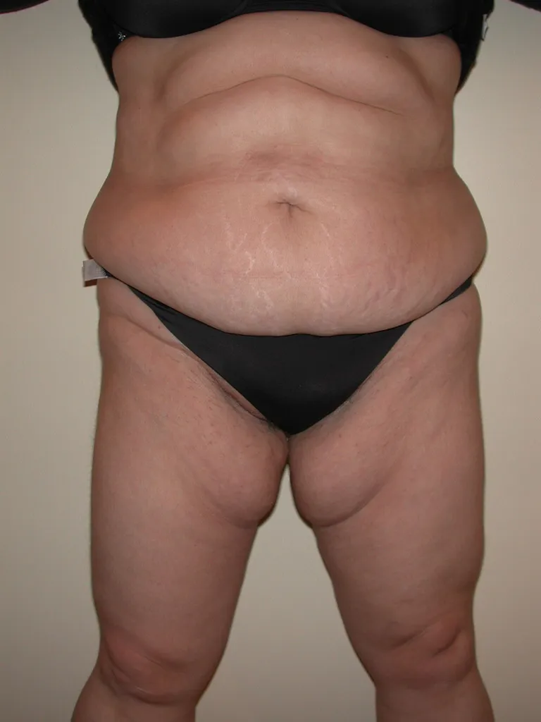 Chirurgie réparatrice extrême à Lyon – Super Bodylift & Remodelage corporel post‑amaigrissement