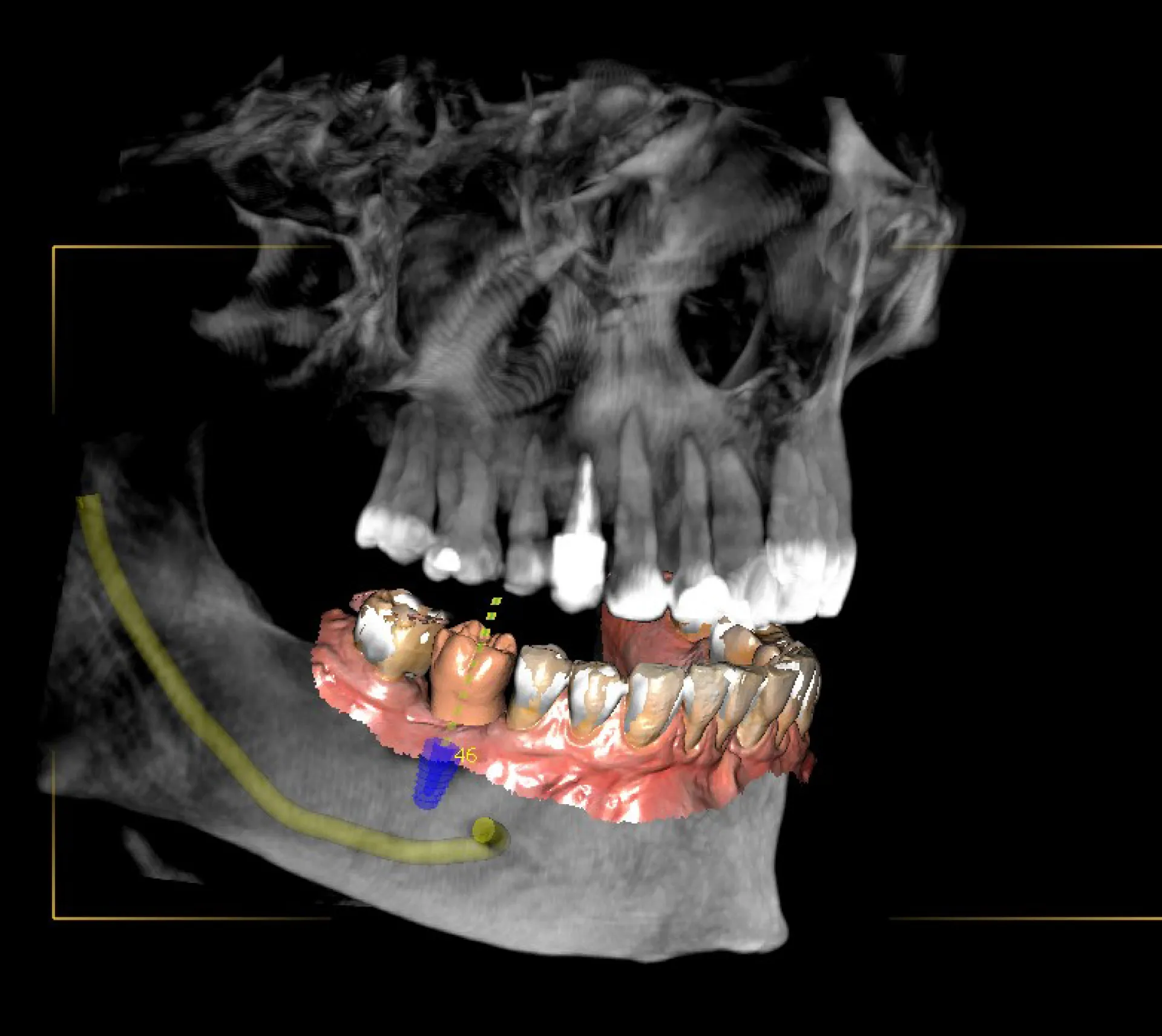 Owandy Cone Beam CBCT I-Max 3D XPRO