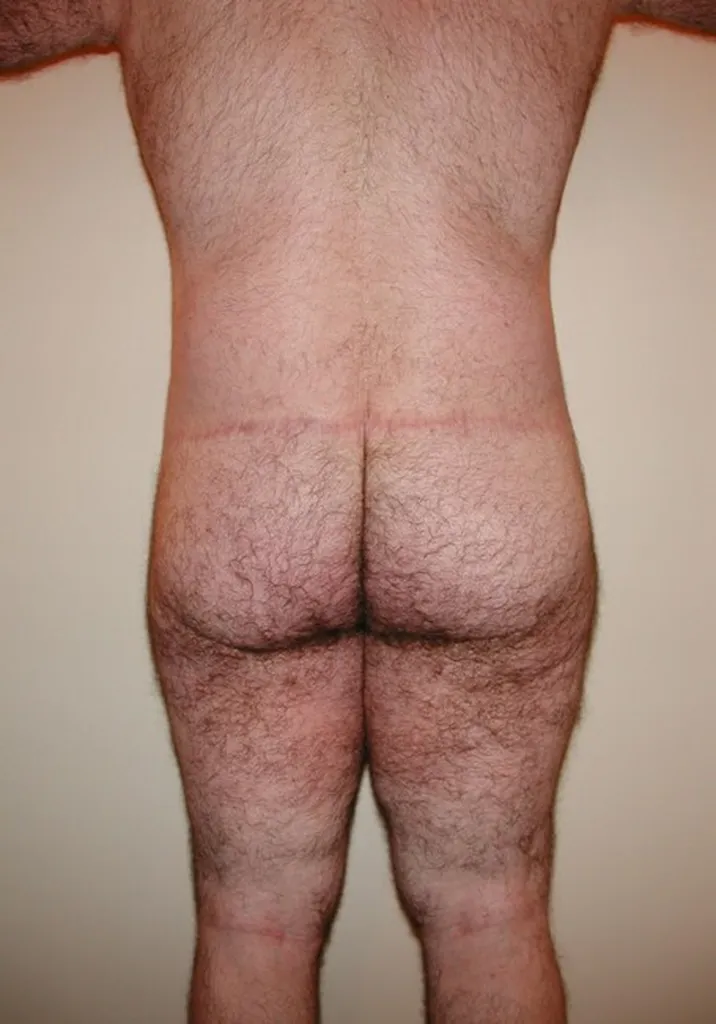 CHIRURGIE DE LA SILHOUETTE CHEZ L'HOMME, LA GYNCOMASTIE ET LE BODYLIFT