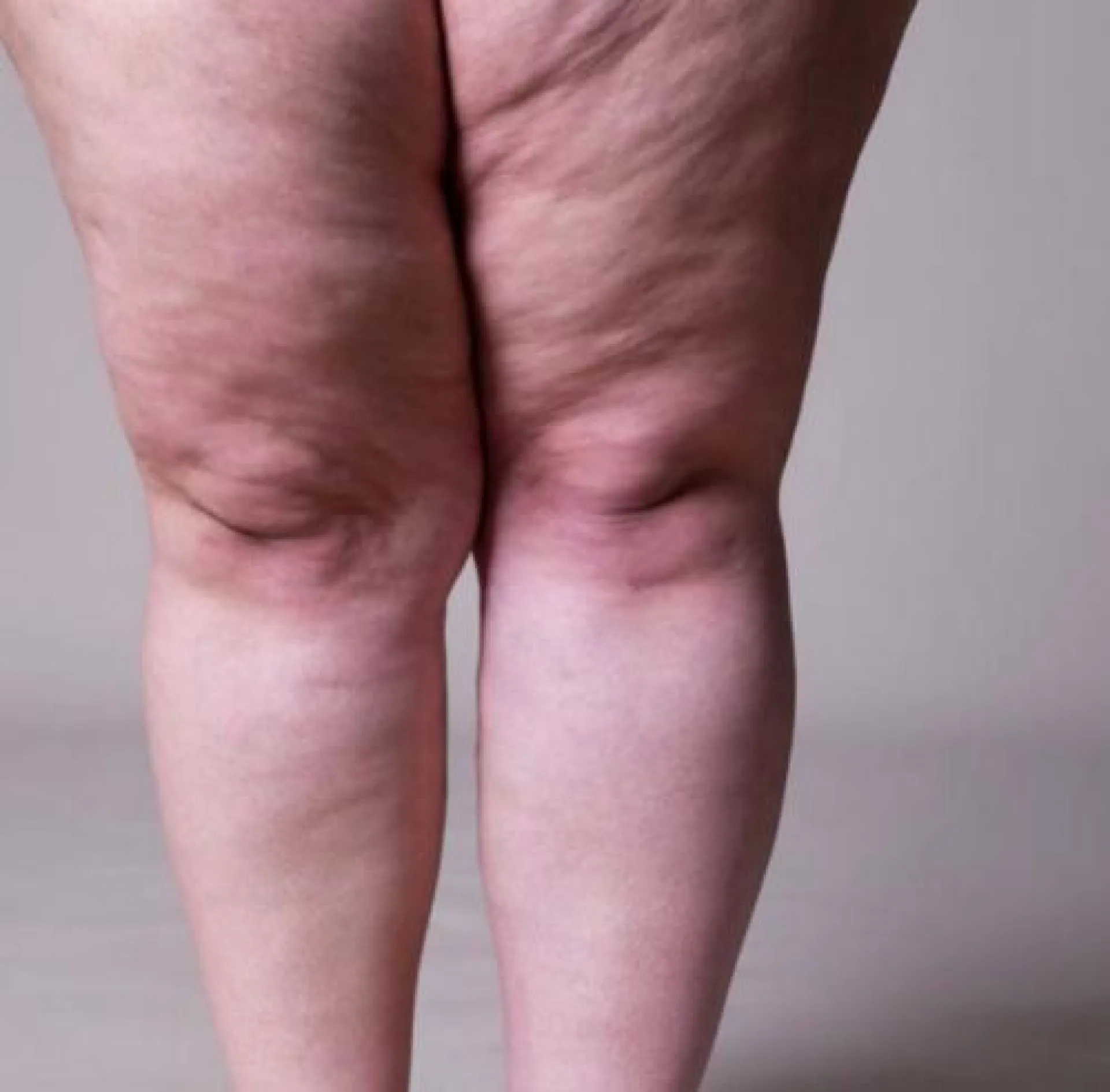 Quelle est la différence entre lipœdème et lymphœdème ? Comprendre et soulager ces troubles à DERMA SUD Castanet-Tolosan, près de Toulouse, et bientôt Saint-Orens-de-Gameville