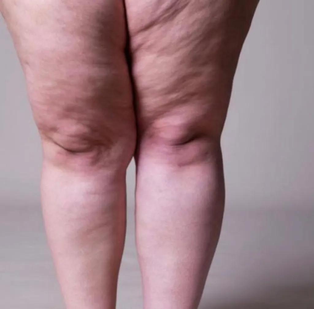 Quelle est la différence entre lipœdème et lymphœdème ? Comprendre et soulager ces troubles à DERMA SUD Castanet-Tolosan, près de Toulouse, et bientôt Saint-Orens-de-Gameville