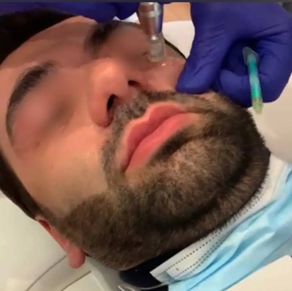 micro-needling qualité de peau profhilo 