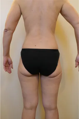 Traitement du lipœdème à Lyon – Liposuccion chirurgicale avancée par un chirurgien esthétique expert