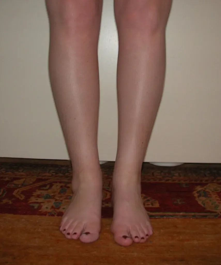 Calf and ankle liposuction in France: Dr Jean-François Pascal’s expertise in Lyon