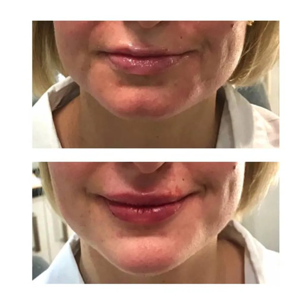 lèvres menton ovale acide hyaluronique Paris6 médecine esthétique