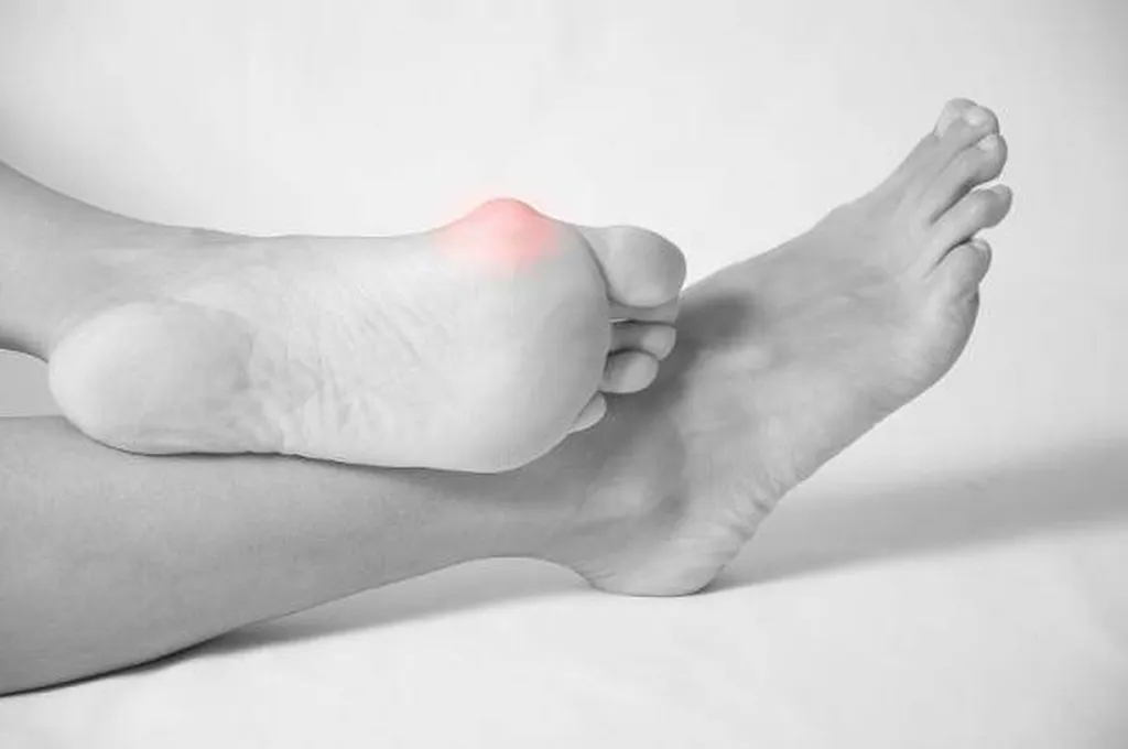 L'Hallux Valgus : Comprendre et Traiter cette Affection Courante