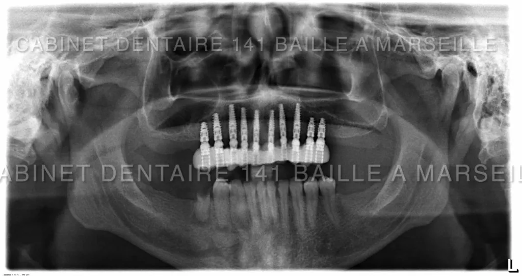 Remplacer toutes ses dents par des implants cabinet 141 baille marseille