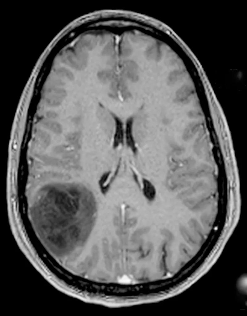 Gliome de bas grade parietal droit
