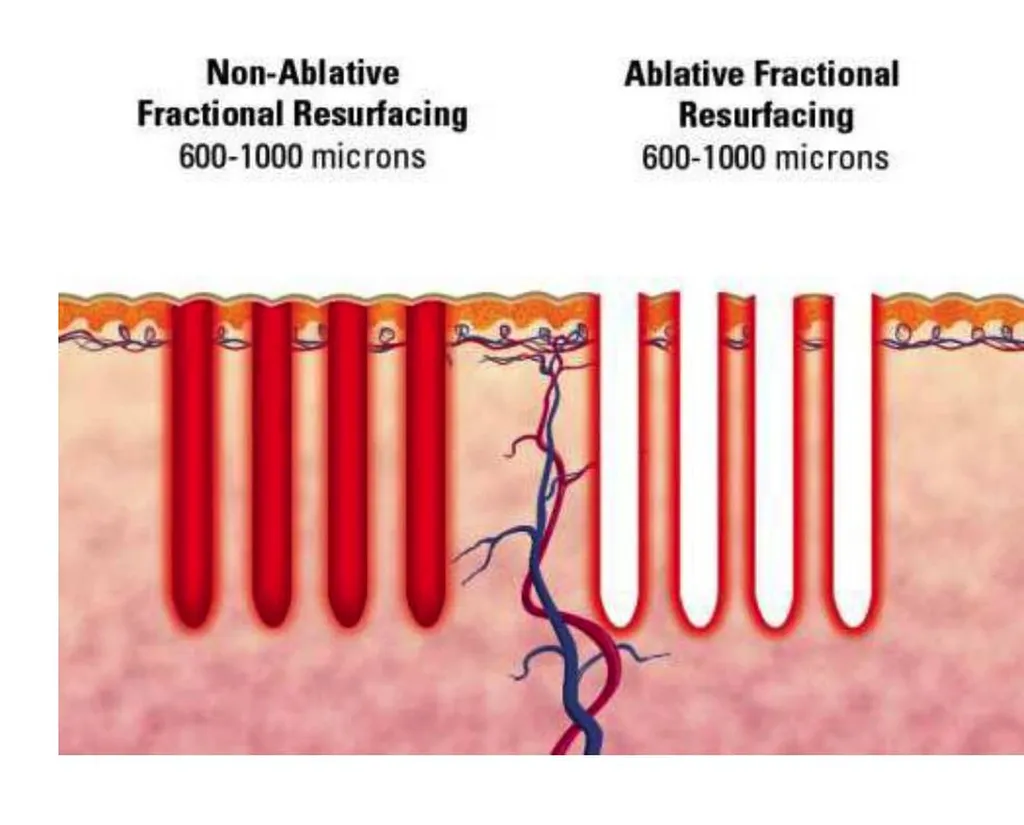 laser qualité de peau profhilo 