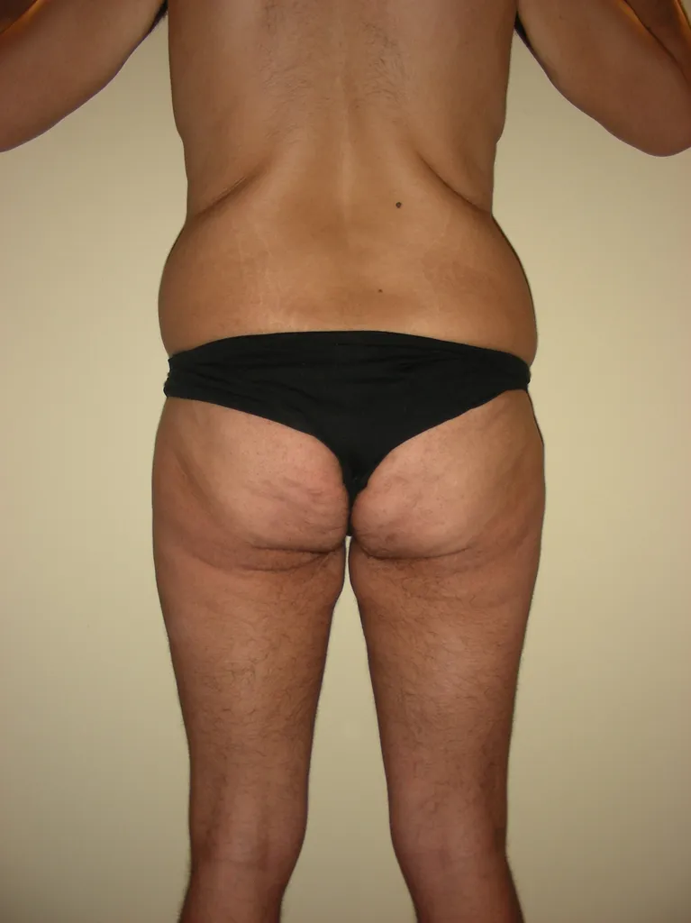 CHIRURGIE DE LA SILHOUETTE CHEZ L'HOMME, LA GYNCOMASTIE ET LE BODYLIFT