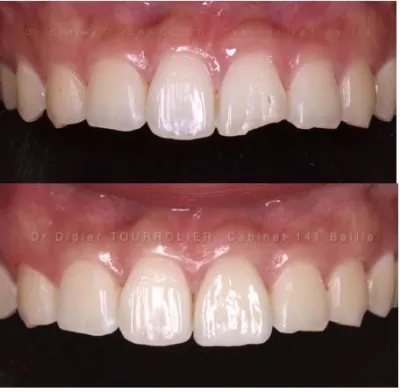 spécialiste facettes Emax 