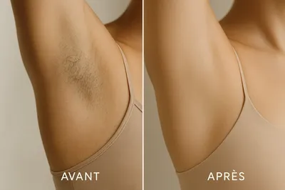 Épilation laser des aisselles avec laser diode Alexandrite et YAG chez Joslayhair & Beauty à Toulouse