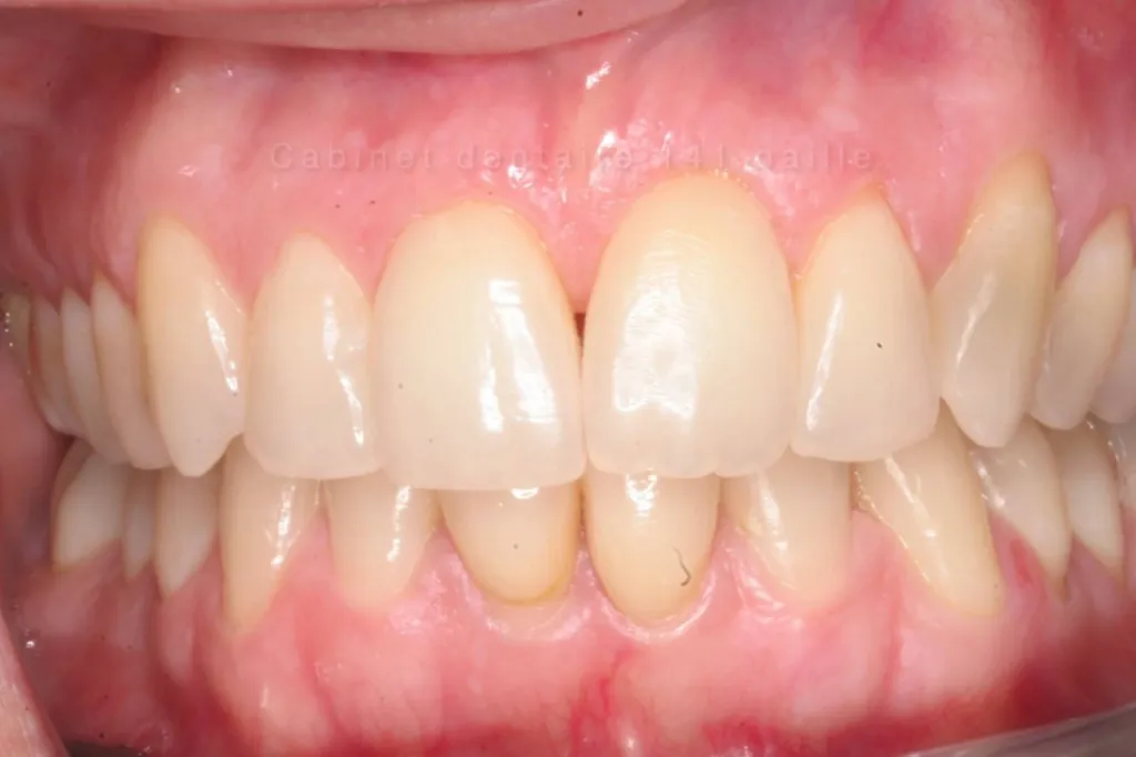 cas invisalign postop docteur tourrolier didier