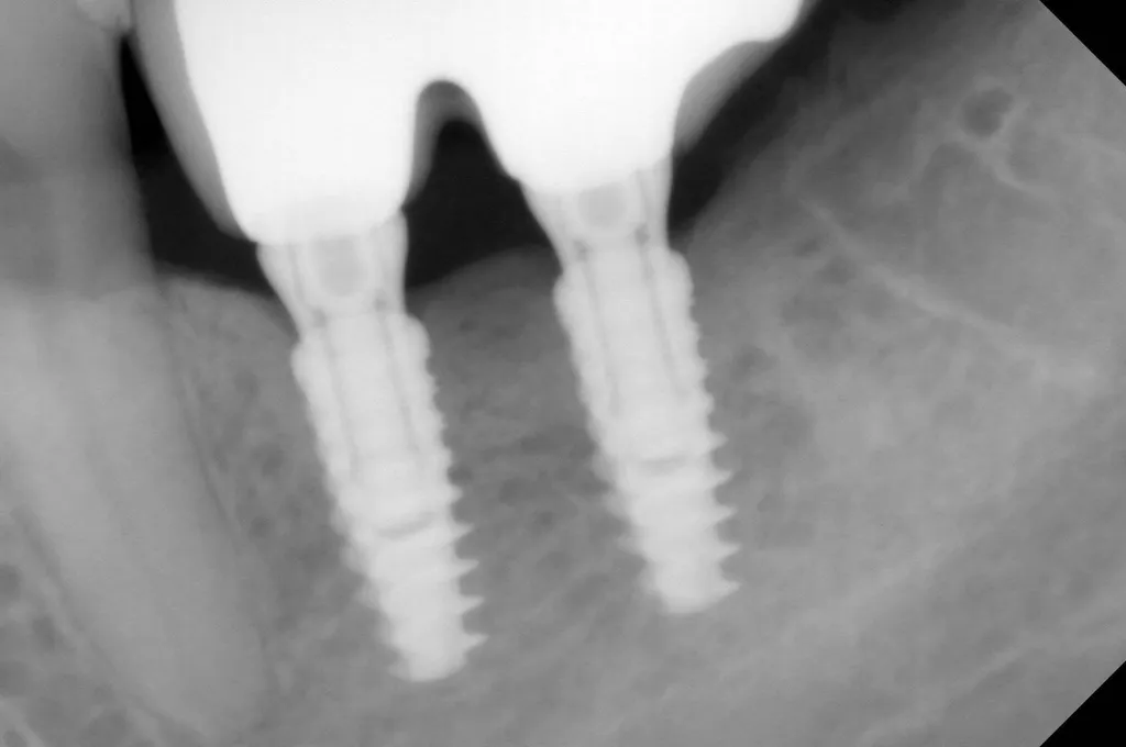 remplacement d'une dent par un implant dentaire marseille
