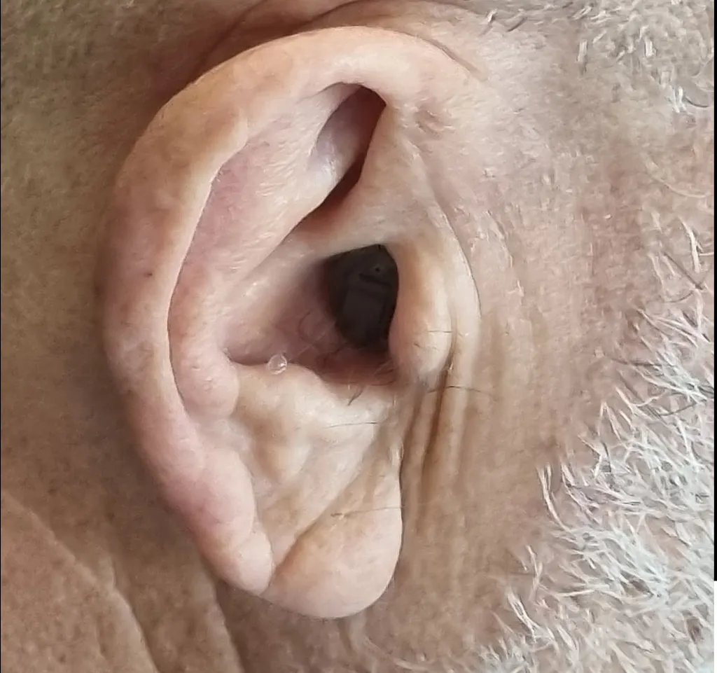 Appareil auditif invisible intra-auriculaire sur mesure : discrétion et performance à Lyon Vaise