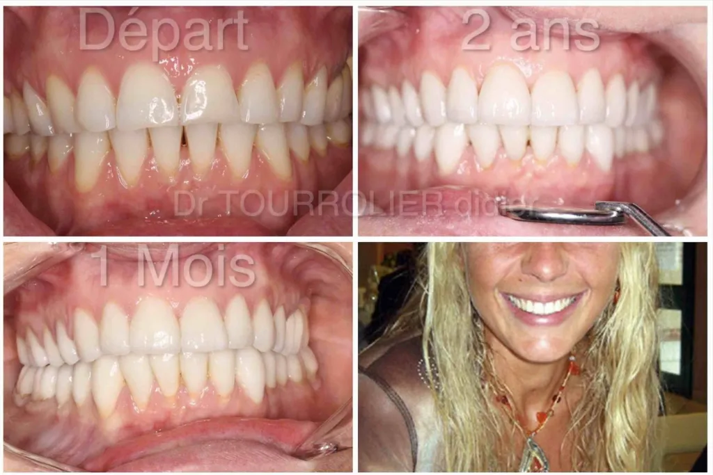 Notre zone d'activité pour ce serviceGouttière invisalign pour aligner les dents du haut