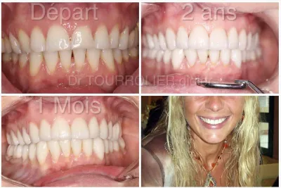 specialiste facettes Emax Marseille