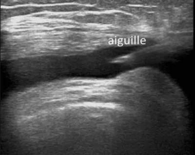 Faire une infiltration sous guidage échographique