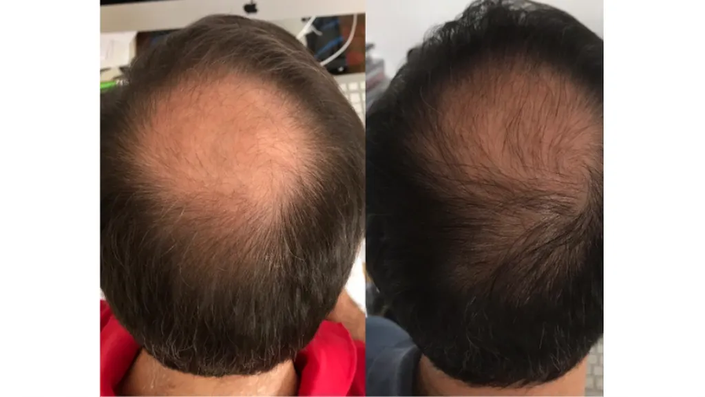 Traitement capillaire pour l'amélioration de la densité des cheveux à Paris