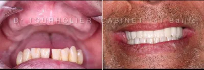 Clinique dentaire spécialisée implantation aracde complète