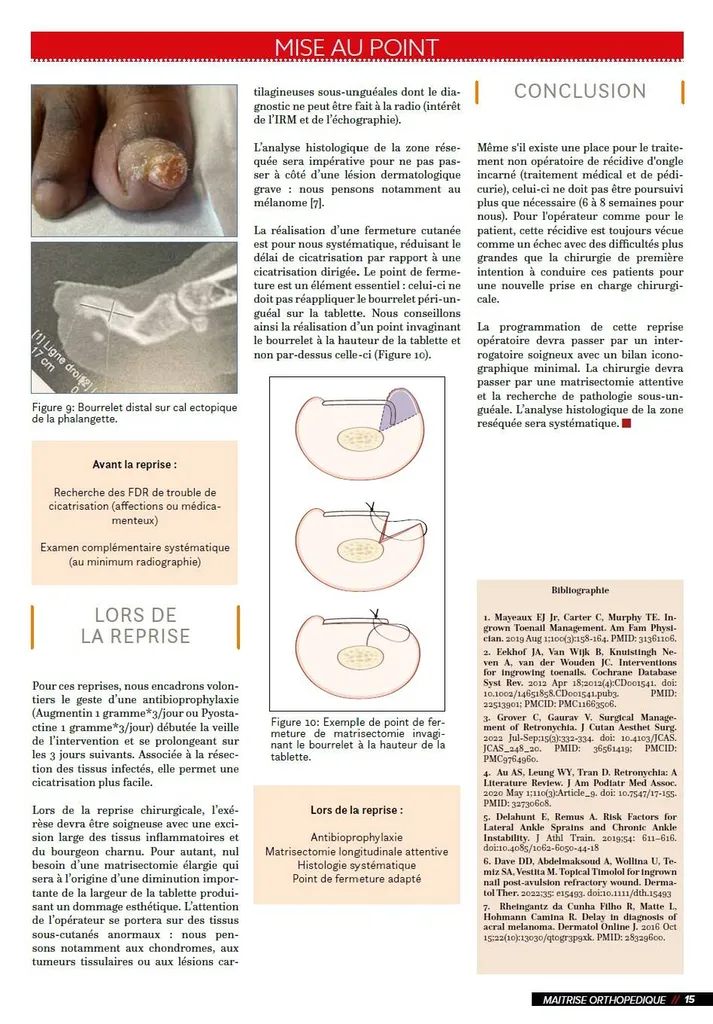 Ongle incarné et récidives, publication du Dr Julien Beldame