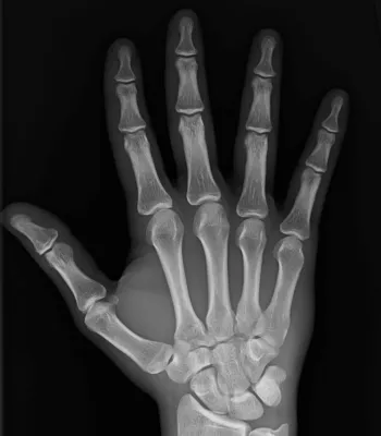 Radiographie de la main