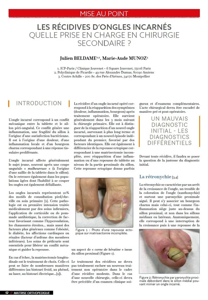 Publication du Dr Julien Beldame, récidive d'ongle incarné