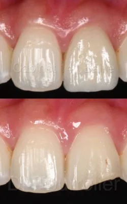 dentiste pour facettes dentaires à marseille