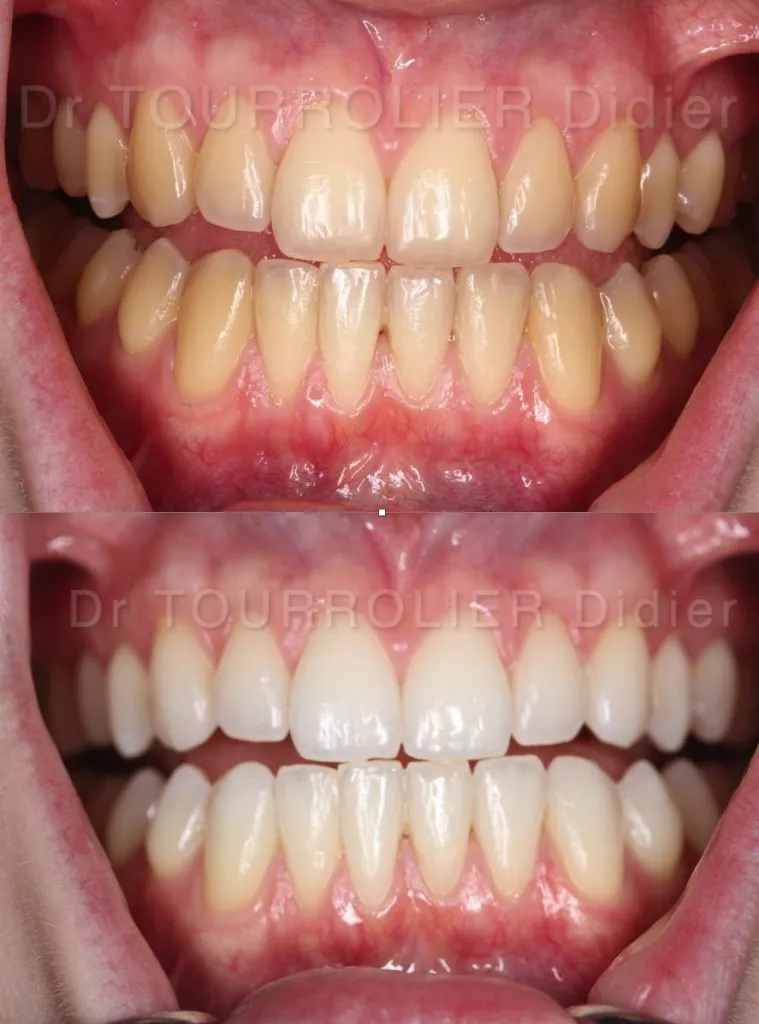 Blanchiment des Dents Marseille