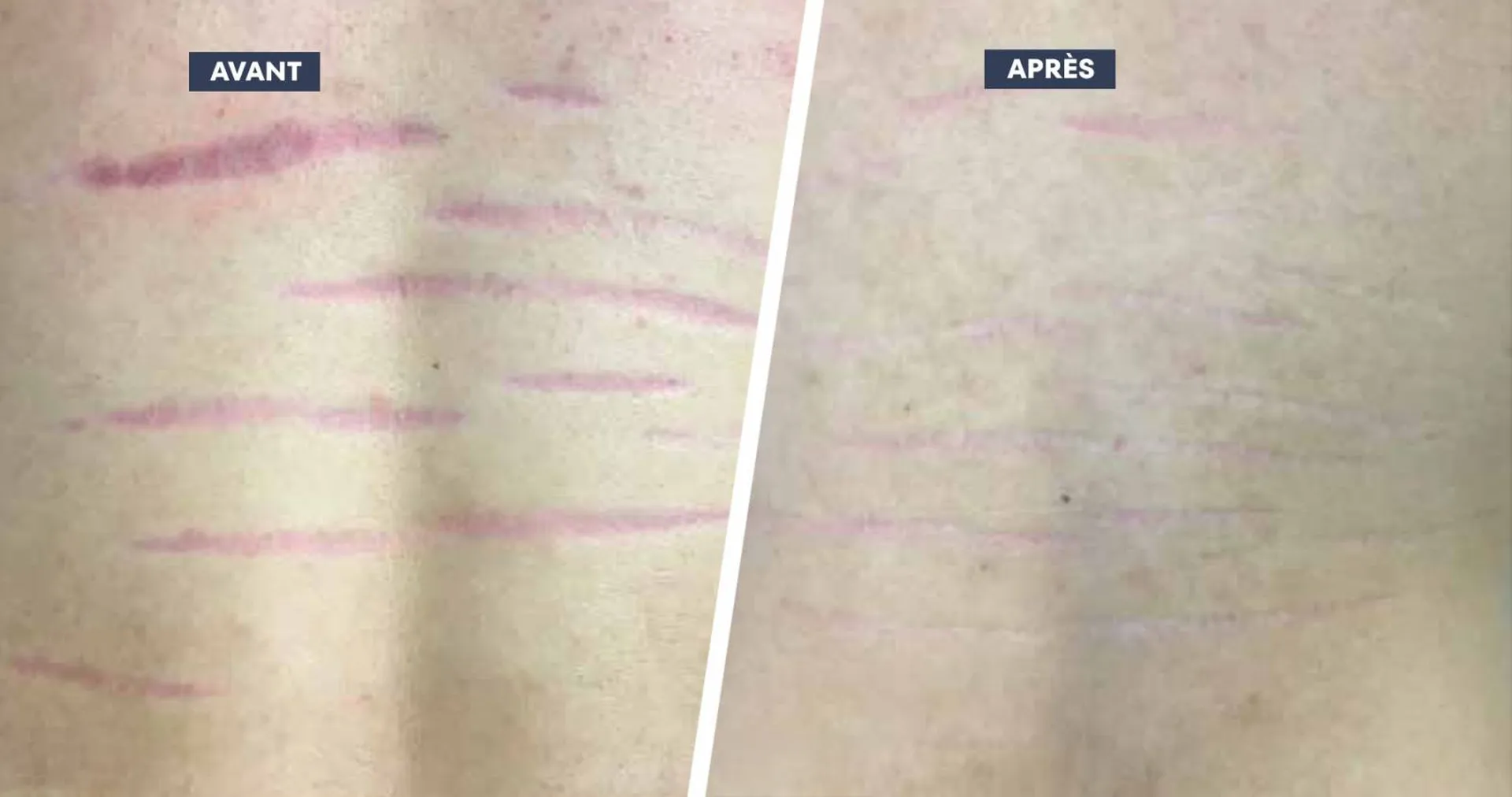 Laser ProDeep et vergetures à Aix-en-Provence