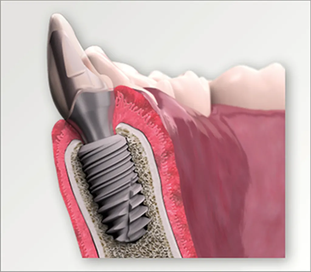 Implants Dentaire France Global D