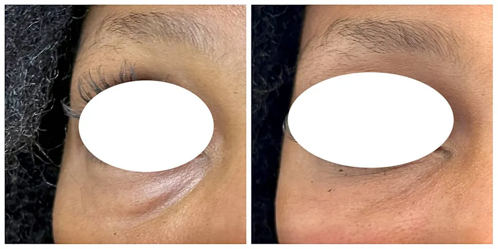 Acide hyaluronique cernes creux Paris 6