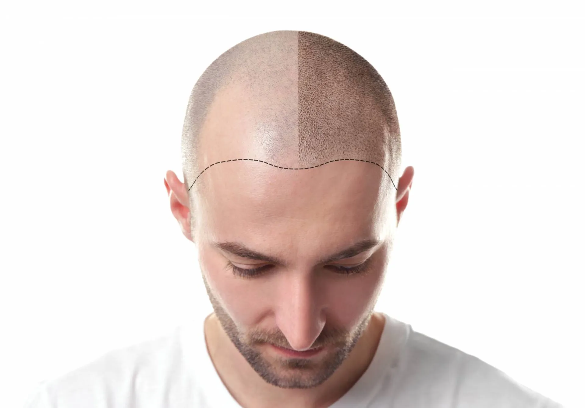 formation tricopigmentation à lyon