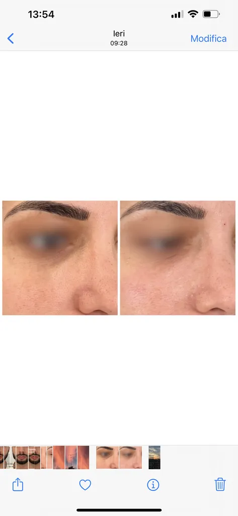 cernes creux acide hyaluronique, profhilo, morpheus