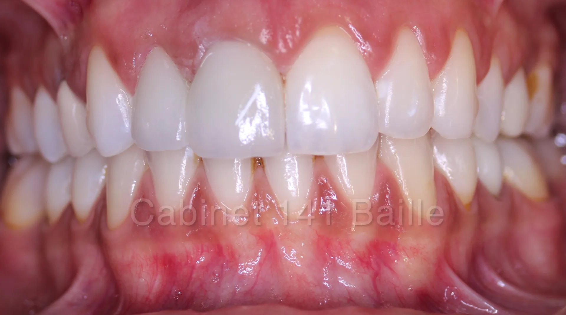 specialiste greffe et sinus lift en implantologie dentaire Marseille