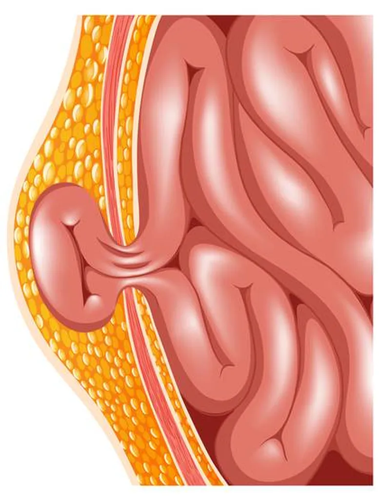 éventration