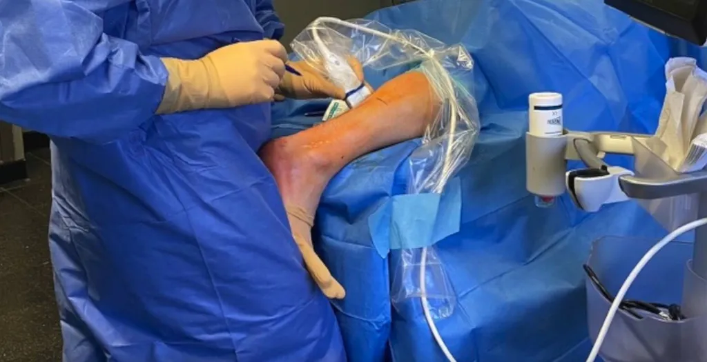 Dr Julien Beldame et la rétraction du tendon d'Achille, ICP Amiens