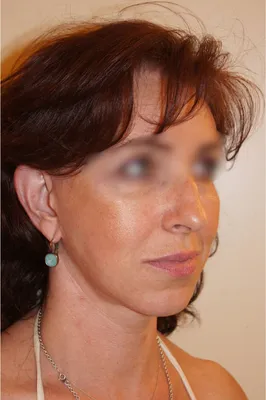 Facial lifting and blepharoplasty: A natural approach to facial rejuvenation in Lyon