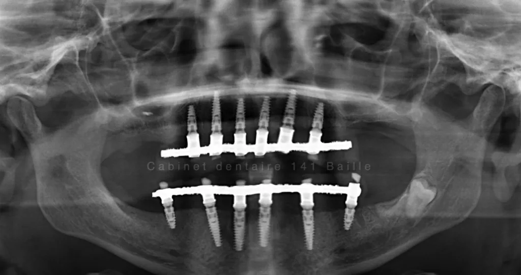 spécialiste implant bouche complète 