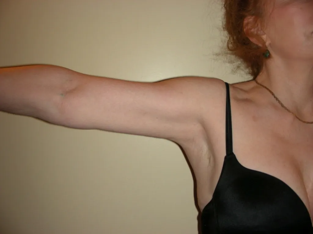 Brachioplastie réparatrice : une chirurgie du corps pour restaurer l’harmonie des bras