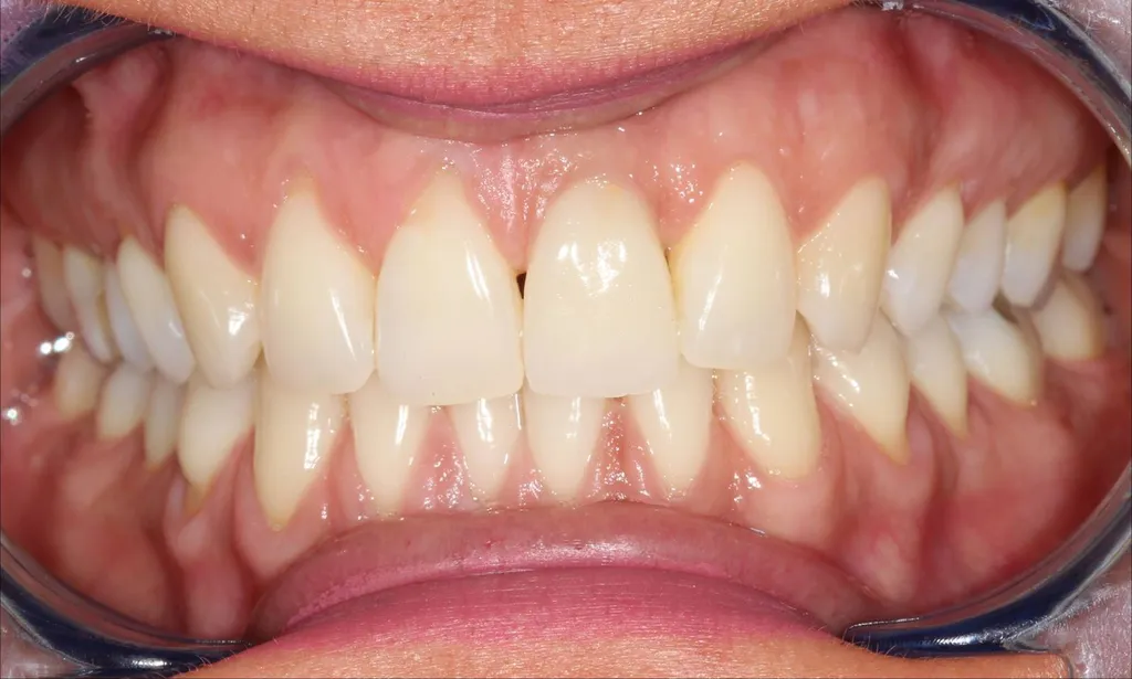 pose un implant incisive 