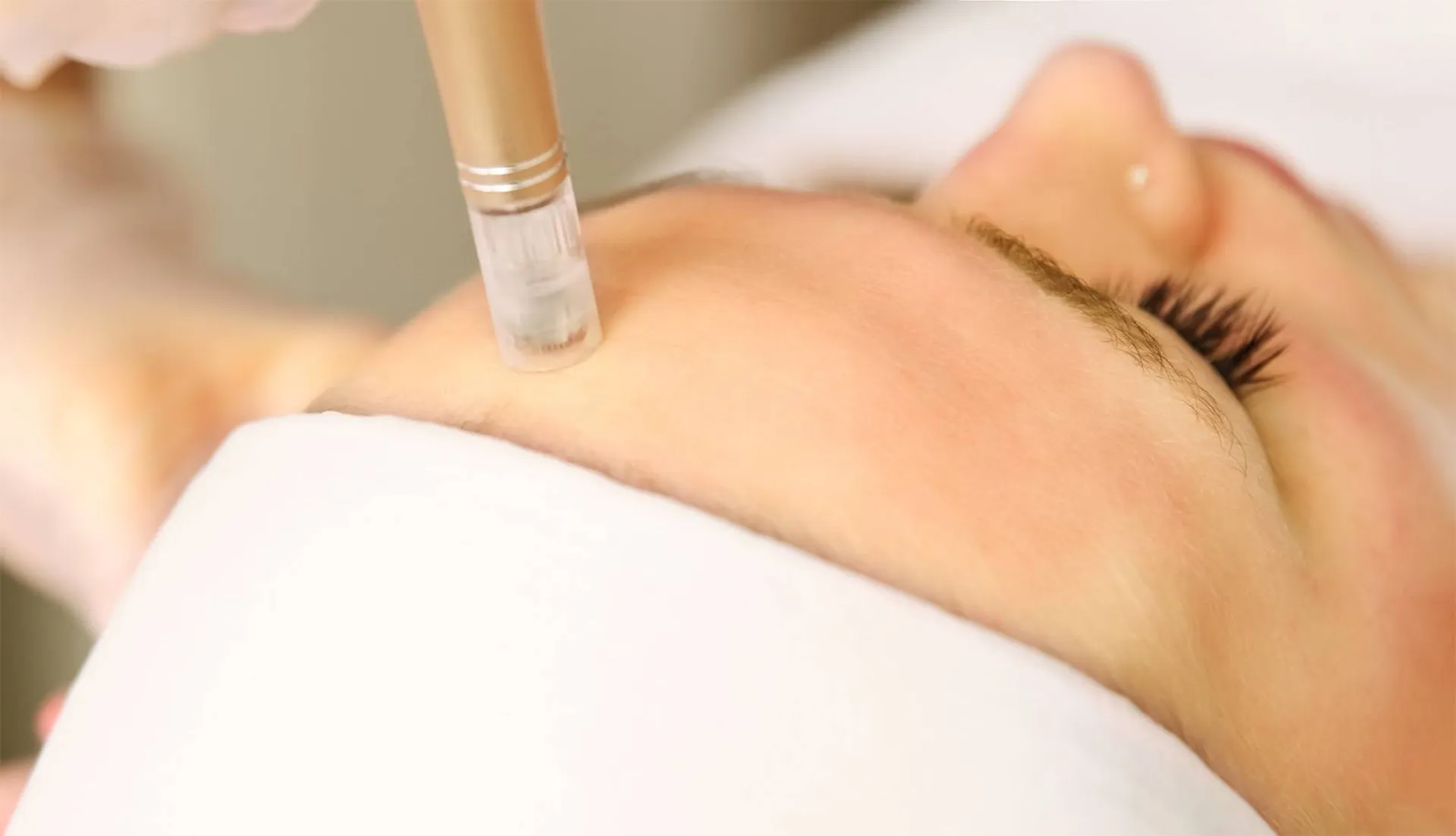 mésothérapie microneedling par un médecin à Aix en Provence