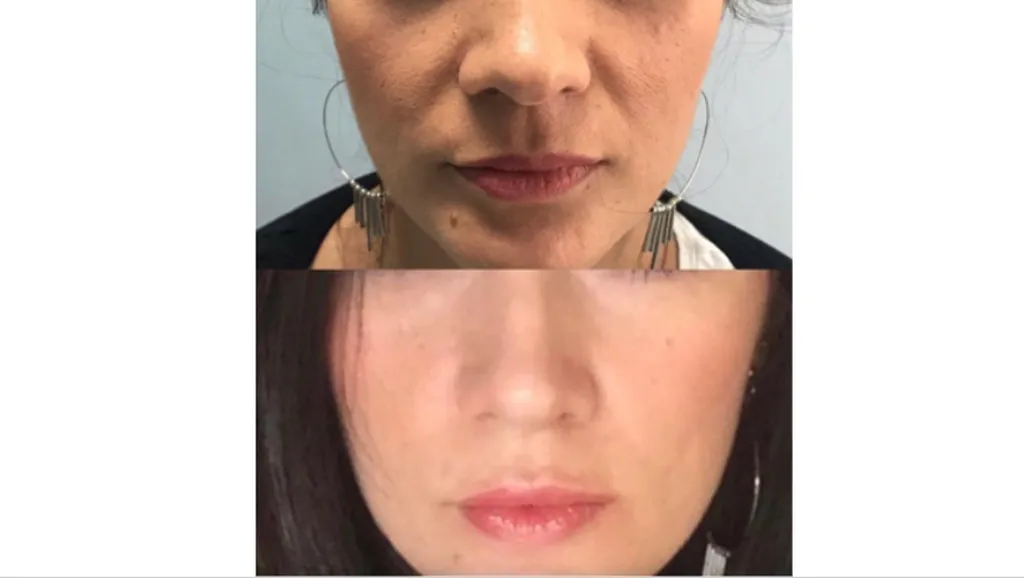 Repulper des lèvres et revitaliser la peau du visage par une injection d’acide hyaluronique à Paris