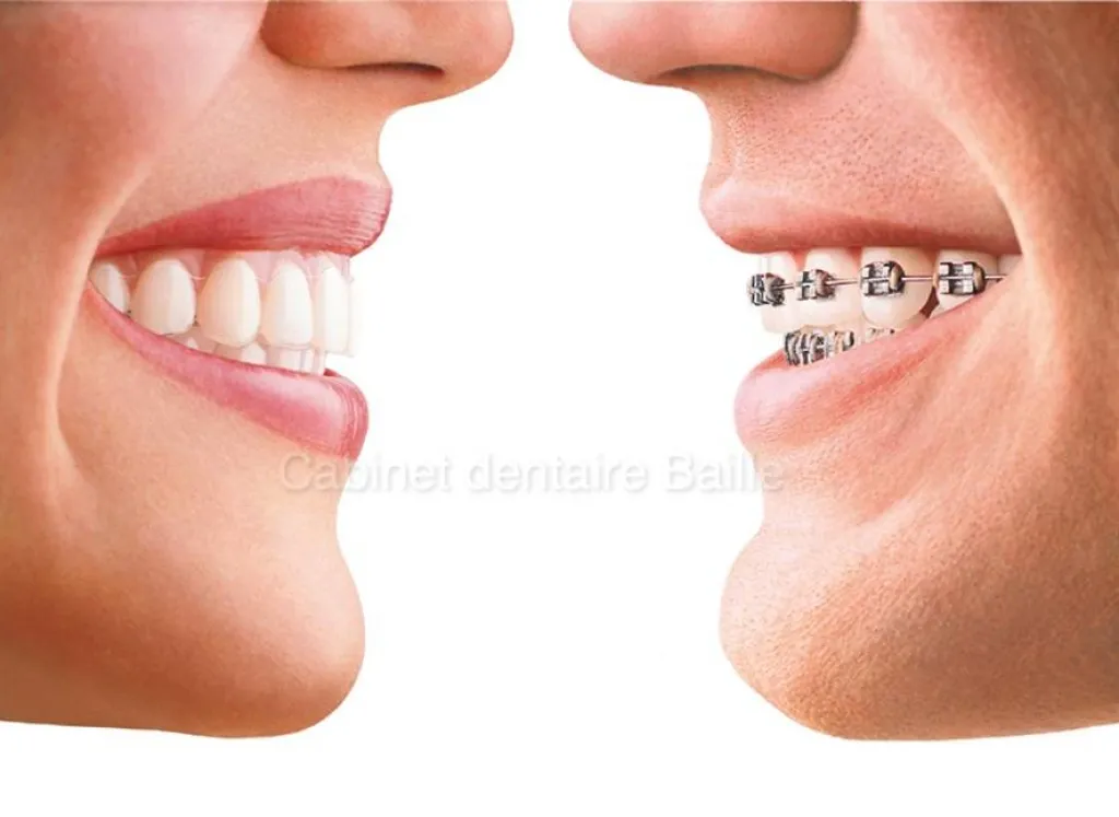 orthodontie Invisalign® Marseille Dr TOURROLIER Didier.