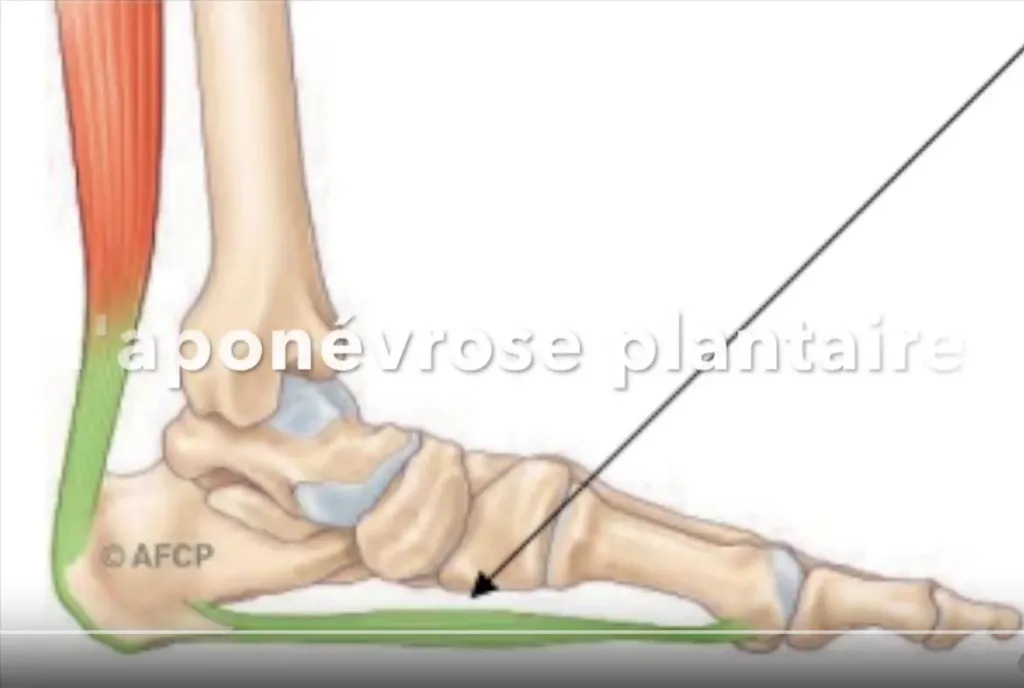 Le Docteur Julien Beldame, orthopédiste et spécialiste de la cheville et du pied, à l'ICP Paris, présente un tutoriel sur l'aponévrosite plantaire et la méthode Walant